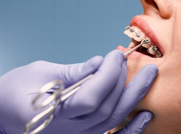 Woman,With,Wired,Metal,Braces,On,Teeth,Receiving,Orthodontic,Treatment.hands