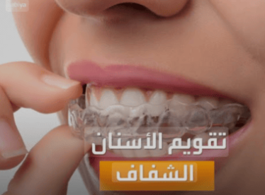 أنواع-تقويم-الأسنان-الشفاف