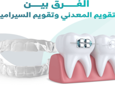 الفرق-بين-التقويم-المعدني-التقليدي-التقويم-السيراميكي