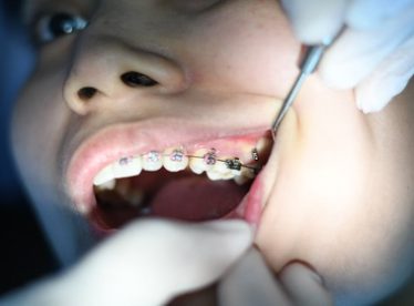 انواع-تقويم-الاسنان-وافضلها