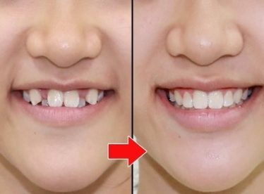 تقويم-الأسنان-قبل-وبعد