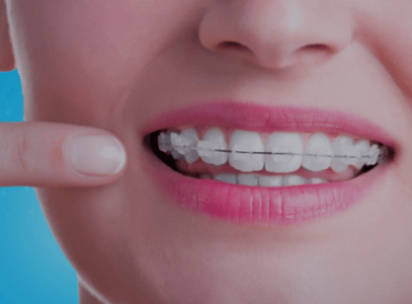 تقويم-الاسنان-الشفاف